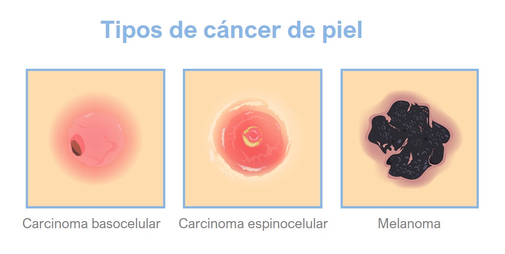 Tipos de cáncer de piel