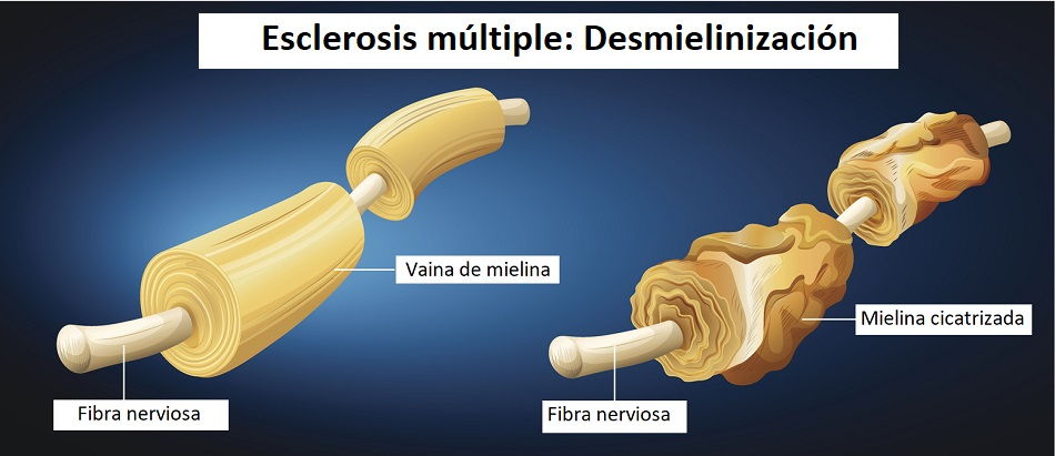 Esclerosis Múltiple: Qué Es, Causas Y Síntomas | Tu Canal De Salud