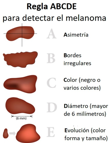 Regla ABCDE para diferenciar entre verrugas o melanomas