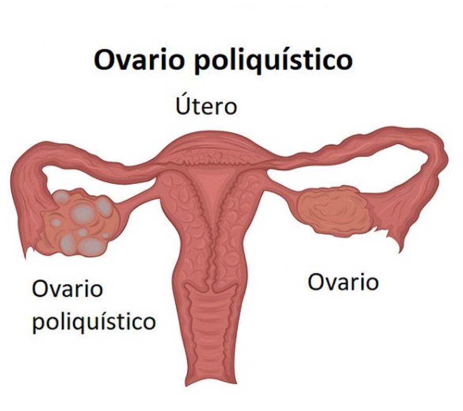 Síntomas Y Riesgos Del Síndrome De Ovario Poliquístico Tu Canal De Salud 0379