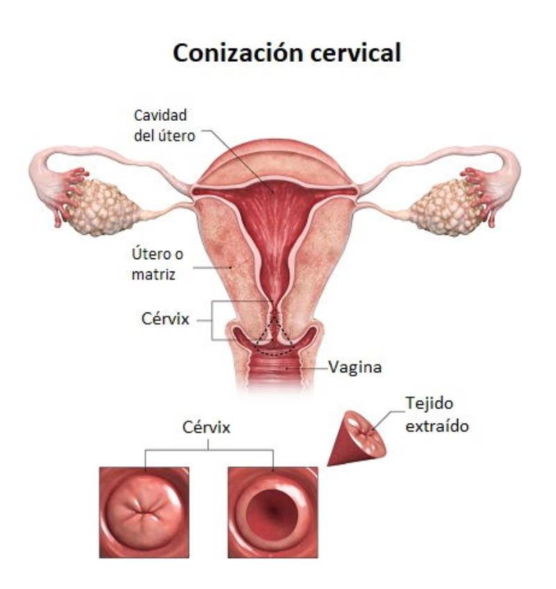 Técnica Para Eliminar Las Lesiones Precancerosas Del Cérvix Tu Canal De Salud 5916