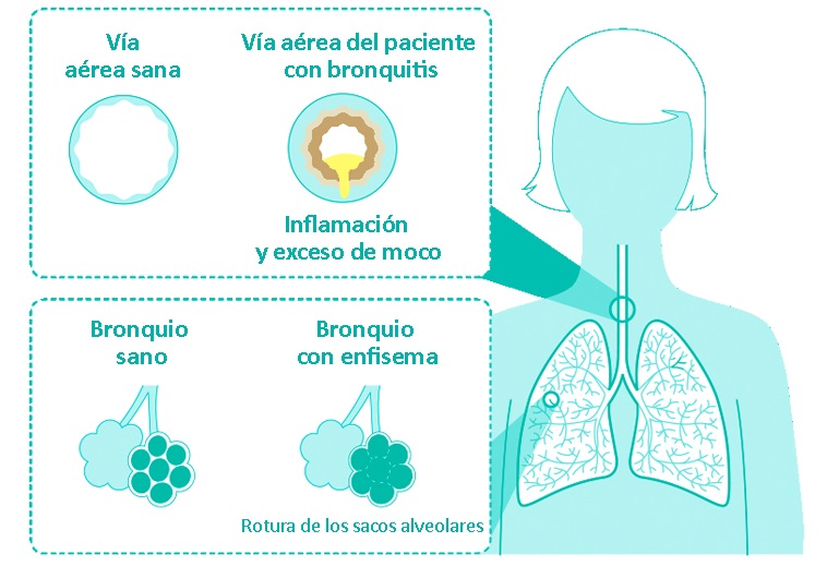 Bronquio con enfisema