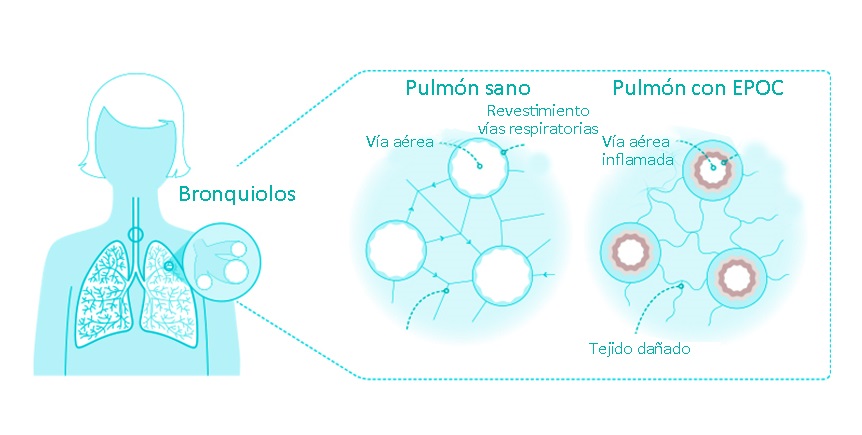 Infografía comparando un pulmón sano con uno con EPOC