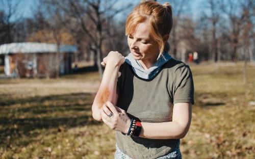 Cómo aliviar los brotes de la psoriasis