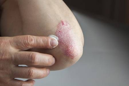 Psoriasis en el codo