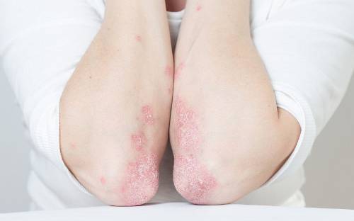 Brote de psoriasis en los codos