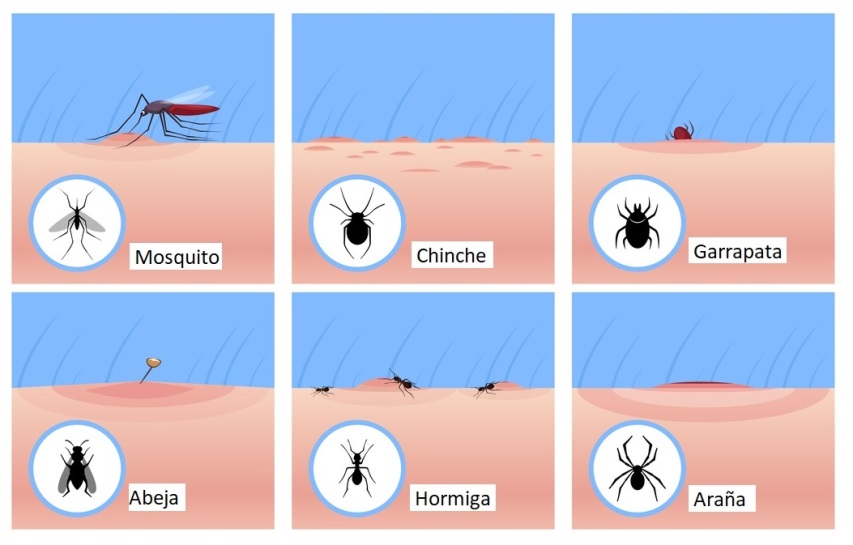 Cómo Aliviar Las Picaduras De Insectos | Tu Canal De Salud