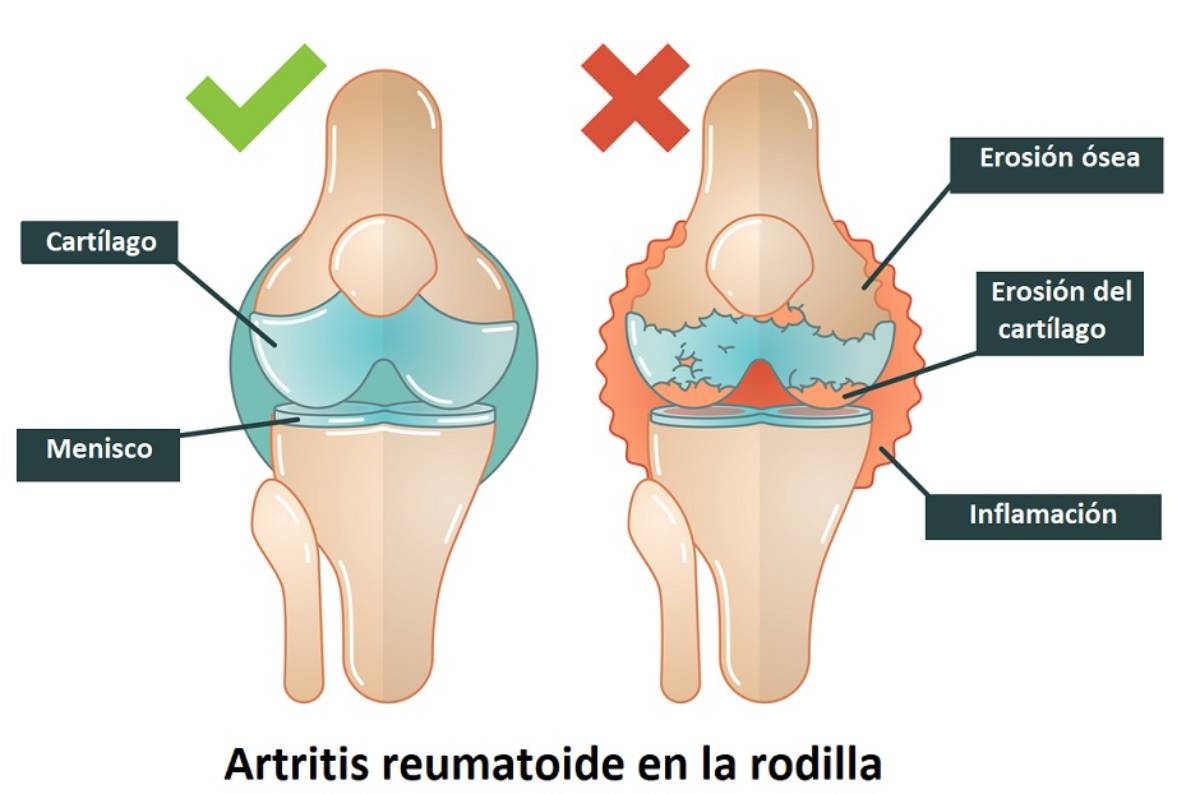 Síntomas Causas Y Prevención De La Artritis Reumatoide Tu Canal De Salud