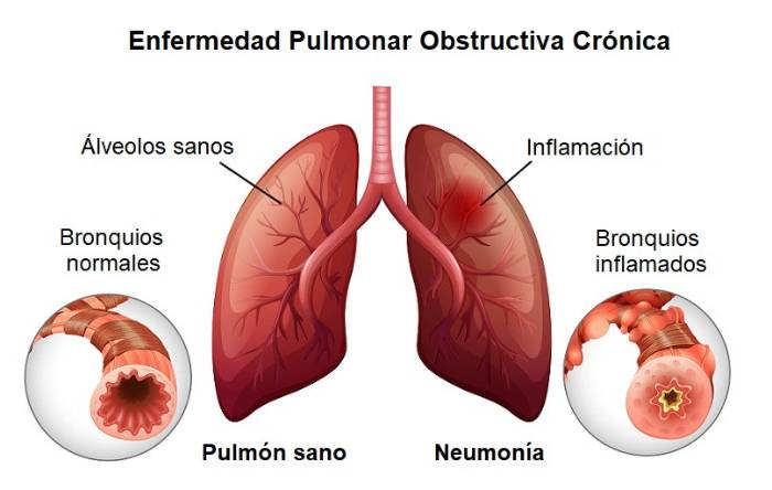 Enfermedad Pulmonar Obstructiva Crónica