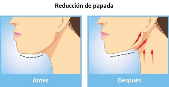 Guía de tratamientos para la Papada - Cuello - Clínicas Mato Ansorena